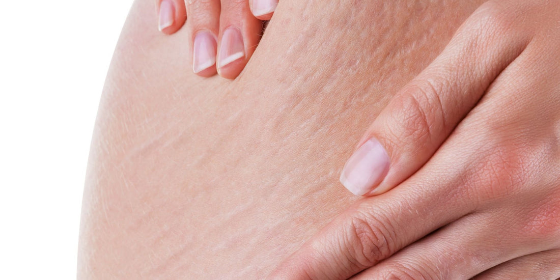 Can a Massage Gun Really Help Diminish the Appearance of Cellulite?