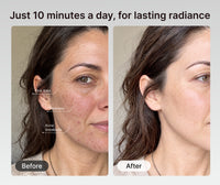 Before and after LED face mask use: fine lines and acne breakouts marked before, clearer-looking skin after