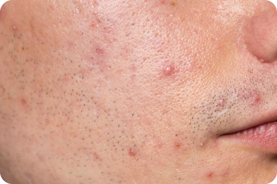 Acne, redness, inflammation